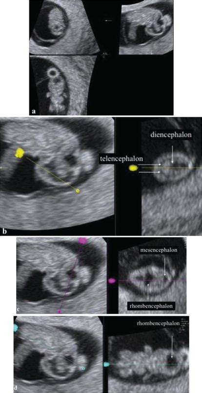mega cisterna magna prognosis|Abnormalities of the Fetal Central Nervous System: .